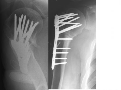 Synthes Locking Humerus Plate (Implant 18)